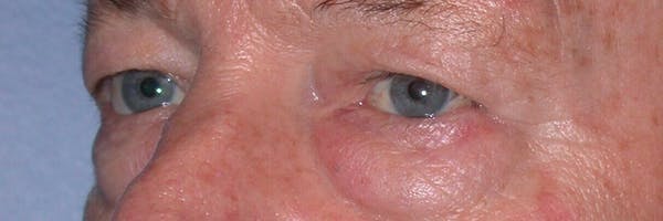 Male Eye Procedures Gallery Before & After Gallery - Patient 6097013 - Image 5