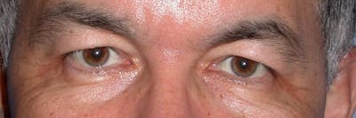 Male Eye Procedures Gallery Before & After Gallery - Patient 6097014 - Image 1