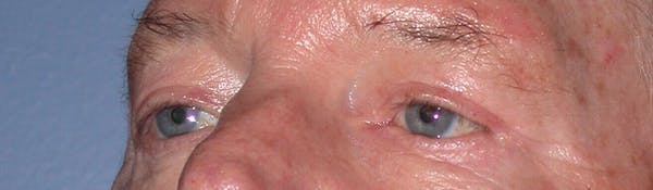 Male Eye Procedures Before & After Gallery - Patient 6097013 - Image 6