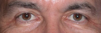 Male Eye Procedures Gallery Before & After Gallery - Patient 6097014 - Image 2