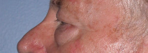 Male Eye Procedures Gallery Before & After Gallery - Patient 6097013 - Image 7
