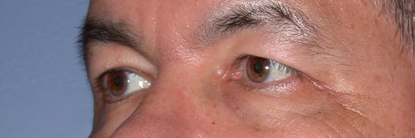Male Eye Procedures Before & After Gallery - Patient 6097014 - Image 3