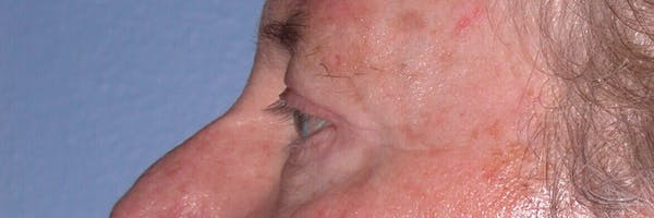 Male Eye Procedures Gallery Before & After Gallery - Patient 6097013 - Image 8
