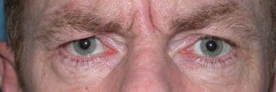 Male Eye Procedures Gallery Before & After Gallery - Patient 6097015 - Image 1
