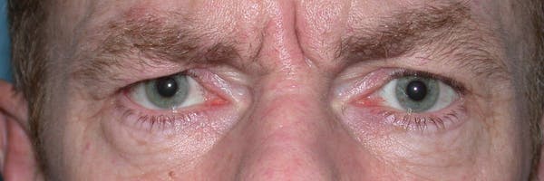 Male Eye Procedures Gallery Before & After Gallery - Patient 6097015 - Image 1