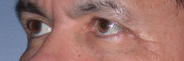 Male Eye Procedures Gallery Before & After Gallery - Patient 6097014 - Image 4