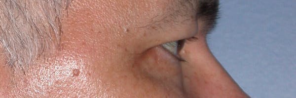 Male Eye Procedures Before & After Gallery - Patient 6097014 - Image 5