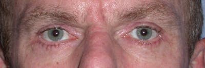 Male Eye Procedures Gallery Before & After Gallery - Patient 6097015 - Image 2