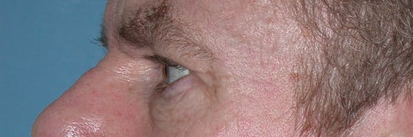 Male Eye Procedures Gallery Before & After Gallery - Patient 6097015 - Image 3