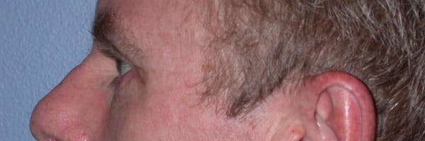 Male Eye Procedures Gallery Before & After Gallery - Patient 6097015 - Image 4
