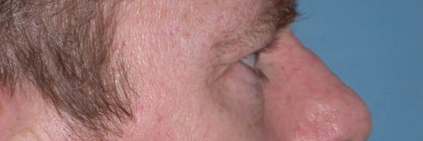 Male Eye Procedures Gallery Before & After Gallery - Patient 6097015 - Image 5