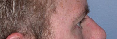 Male Eye Procedures Gallery Before & After Gallery - Patient 6097015 - Image 6