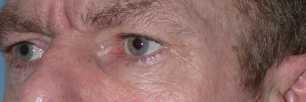 Male Eye Procedures Gallery Before & After Gallery - Patient 6097015 - Image 7