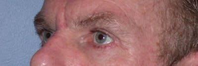 Male Eye Procedures Gallery Before & After Gallery - Patient 6097015 - Image 8