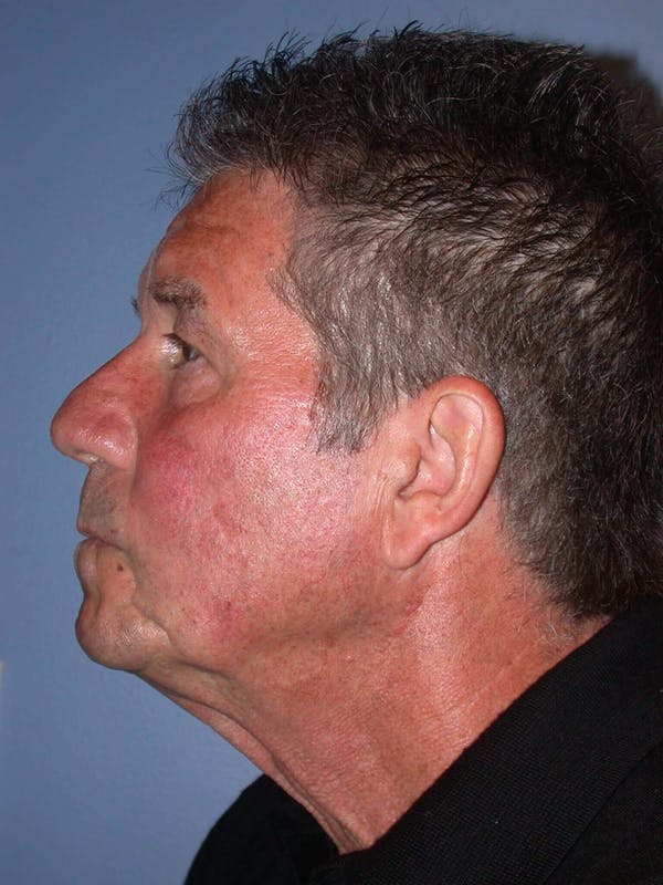 Male Neck Procedures Gallery Before & After Gallery - Patient 6097044 - Image 3