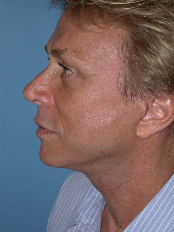 Male Neck Procedures Gallery Before & After Gallery - Patient 6097043 - Image 6