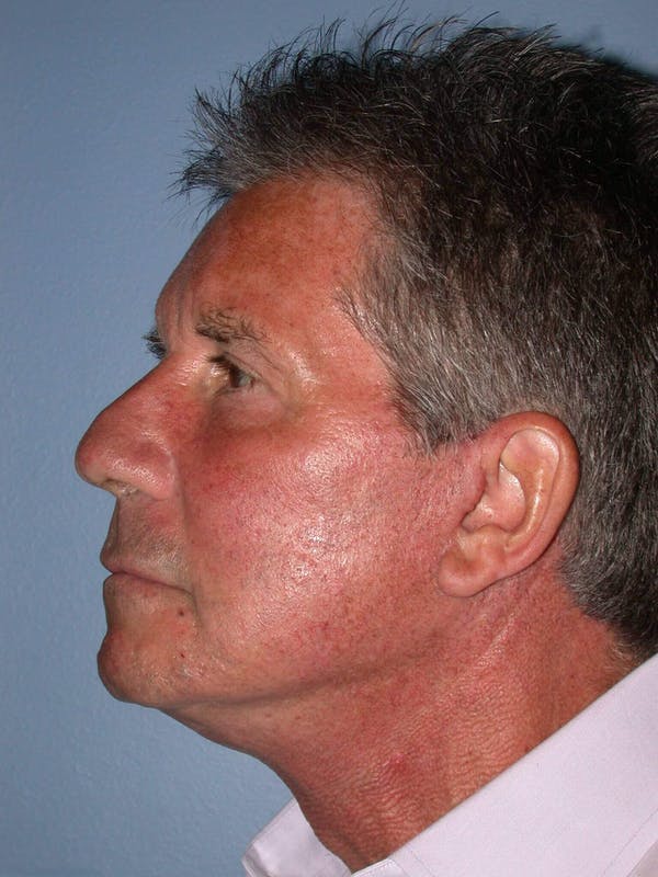 Male Neck Procedures Gallery Before & After Gallery - Patient 6097044 - Image 4