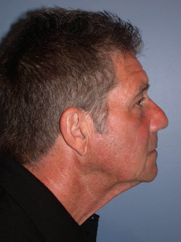 Male Neck Procedures Gallery Before & After Gallery - Patient 6097044 - Image 5