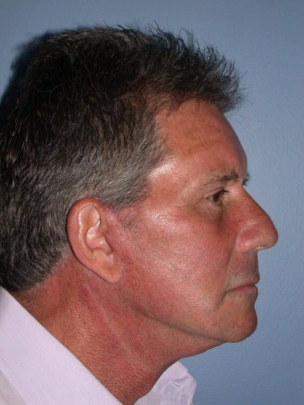 Male Neck Procedures Gallery Before & After Gallery - Patient 6097044 - Image 6