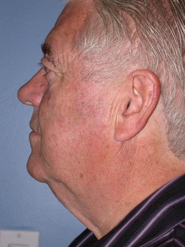 Male Neck Procedures Gallery Before & After Gallery - Patient 6097046 - Image 3
