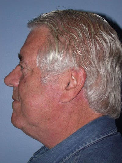 Male Neck Procedures Gallery Before & After Gallery - Patient 6097046 - Image 4