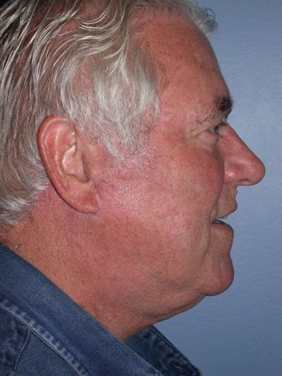 Male Neck Procedures Gallery Before & After Gallery - Patient 6097046 - Image 6