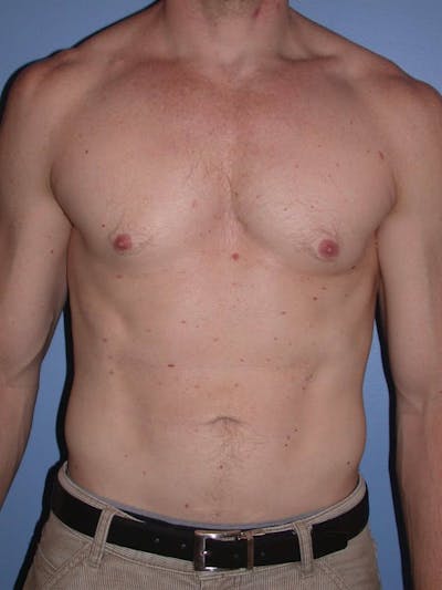 Male Liposuction Gallery Before & After Gallery - Patient 6097146 - Image 2