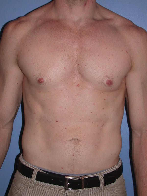 Male Liposuction Before & After Gallery - Patient 6097146 - Image 2