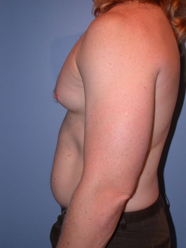 Male Liposuction Gallery Before & After Gallery - Patient 6097146 - Image 3