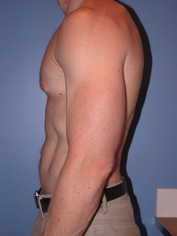 Male Liposuction Gallery Before & After Gallery - Patient 6097146 - Image 4