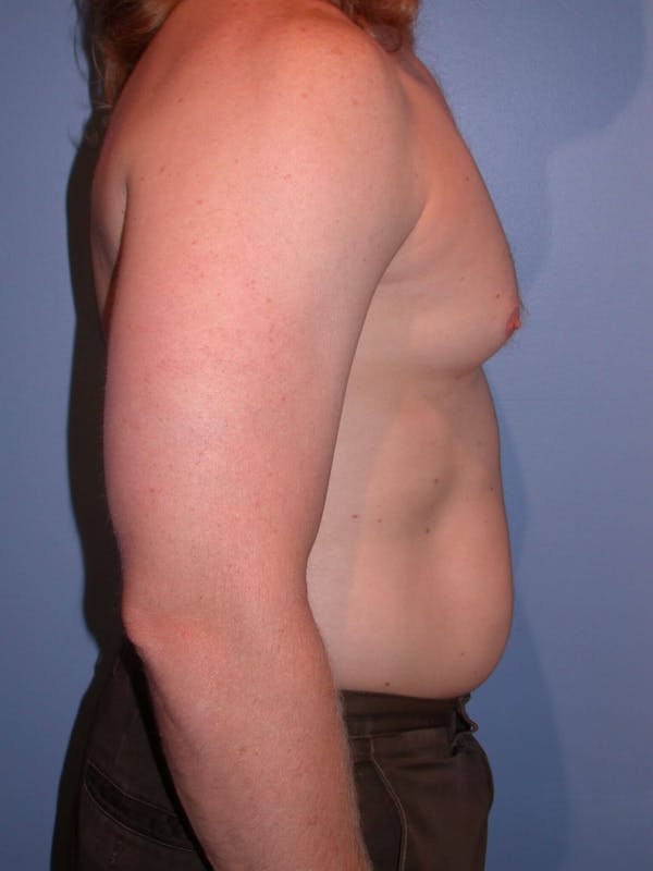 Male Liposuction Gallery Before & After Gallery - Patient 6097146 - Image 5
