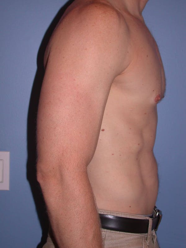 Male Liposuction Gallery Before & After Gallery - Patient 6097146 - Image 6