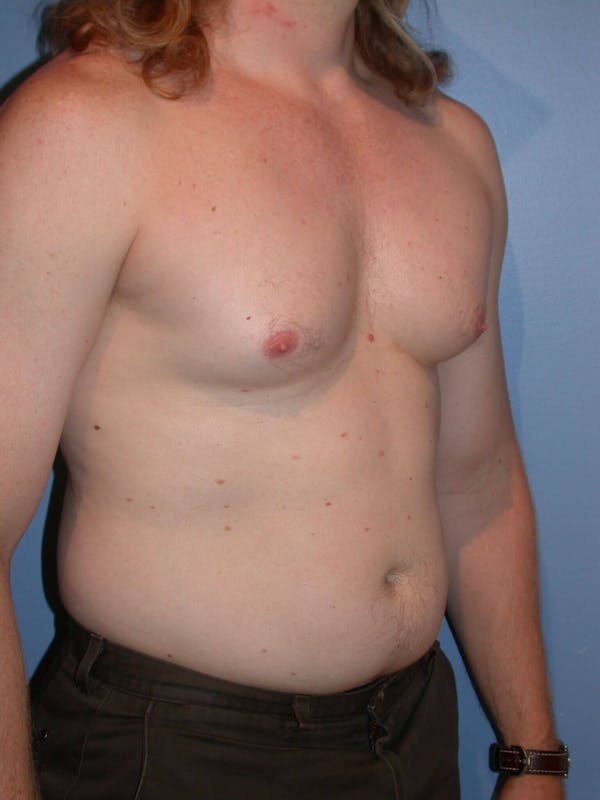Male Liposuction Gallery Before & After Gallery - Patient 6097146 - Image 7