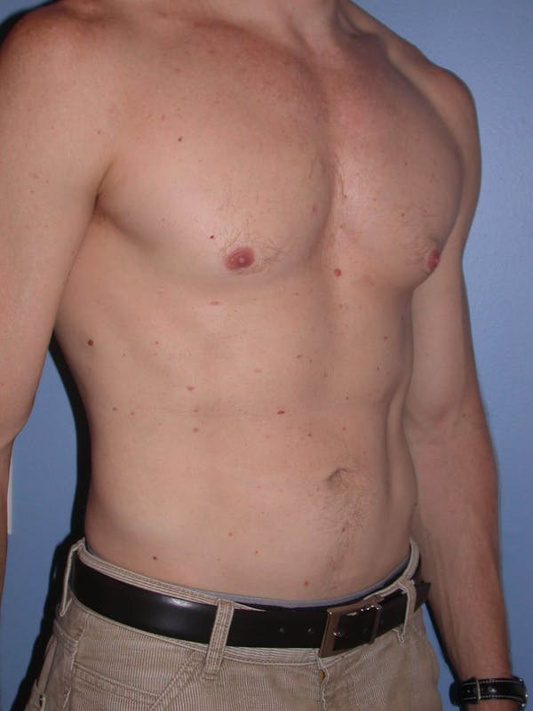 Male Liposuction Before & After Gallery - Patient 6097146 - Image 8