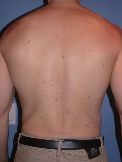 Male Liposuction Gallery Before & After Gallery - Patient 6097146 - Image 10