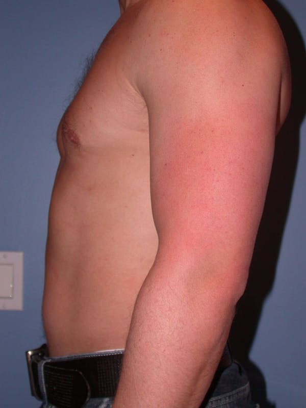 Male Liposuction Gallery Before & After Gallery - Patient 6097147 - Image 3