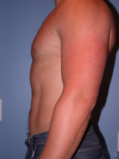 Male Liposuction Gallery Before & After Gallery - Patient 6097147 - Image 4