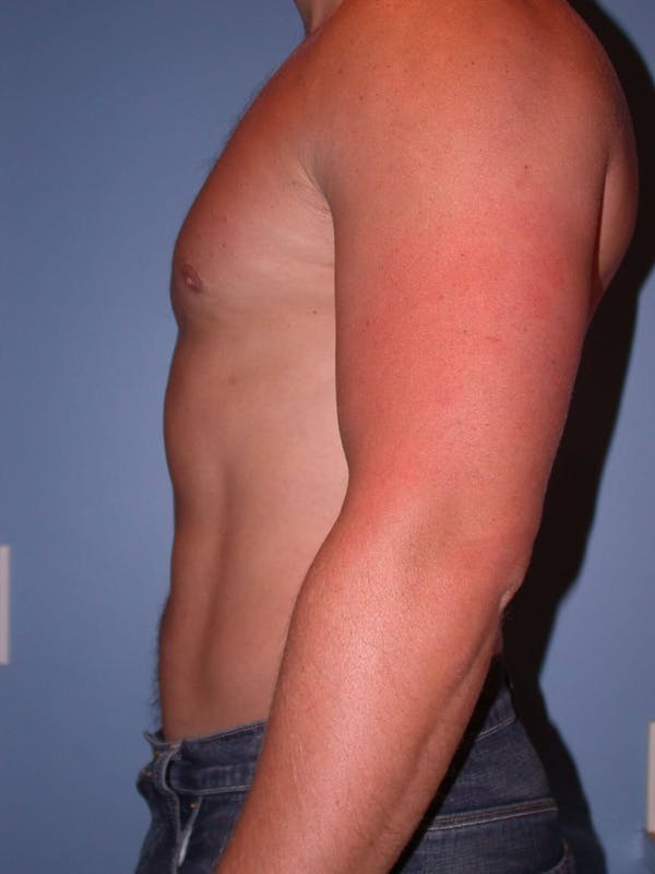 Male Liposuction Gallery - Patient 6097147 - Image 4