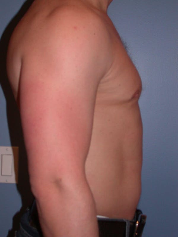 Male Liposuction Gallery Before & After Gallery - Patient 6097147 - Image 5