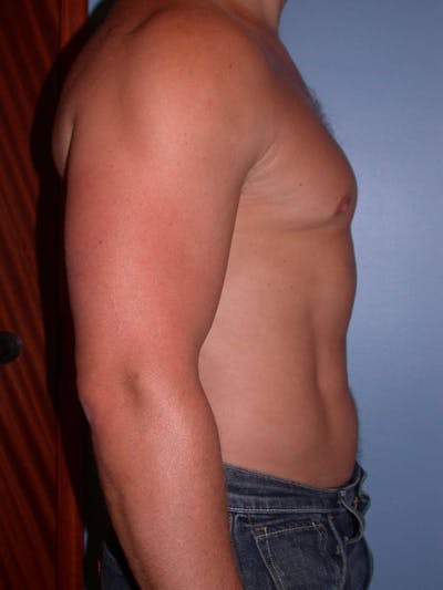 Male Liposuction Gallery Before & After Gallery - Patient 6097147 - Image 6