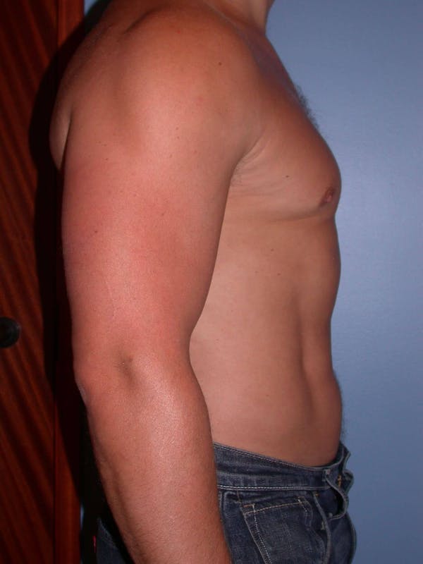 Male Liposuction Gallery Before & After Gallery - Patient 6097147 - Image 6