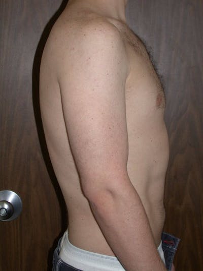Male Liposuction Gallery Before & After Gallery - Patient 6097148 - Image 4