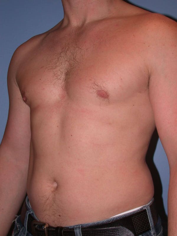 Male Liposuction Gallery Before & After Gallery - Patient 6097147 - Image 7