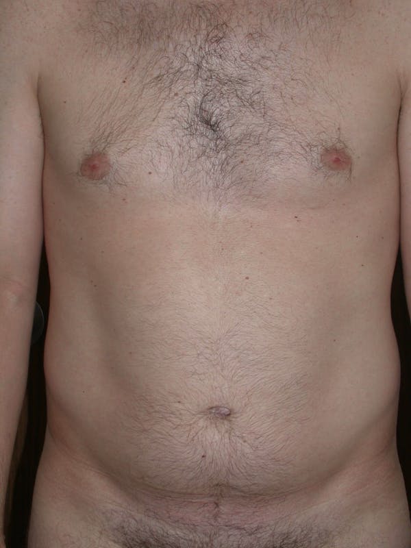 Male Liposuction Gallery Before & After Gallery - Patient 6097148 - Image 5