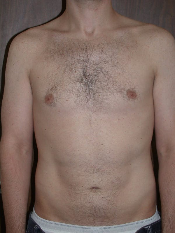 Male Liposuction Gallery Before & After Gallery - Patient 6097148 - Image 6