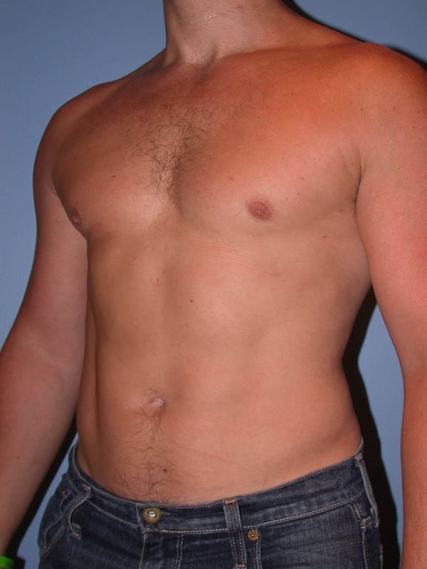 Male Liposuction Gallery Before & After Gallery - Patient 6097147 - Image 8