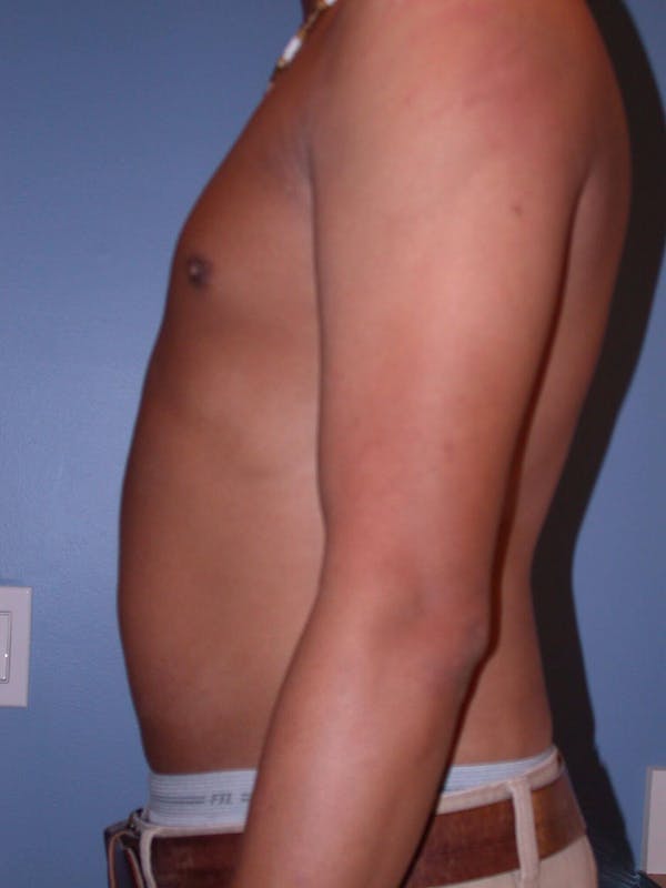 Male Liposuction Gallery Before & After Gallery - Patient 6097149 - Image 3