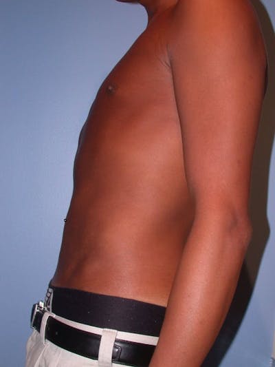 Male Liposuction Before & After Gallery - Patient 6097149 - Image 4