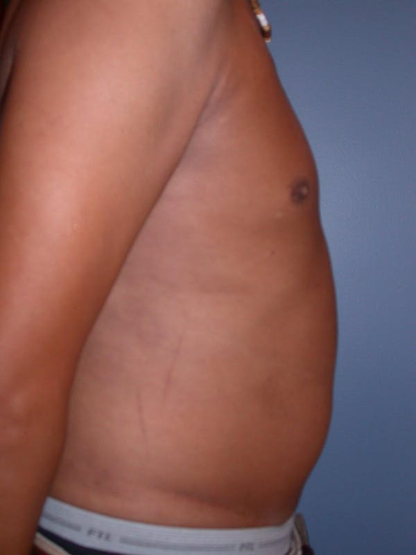 Male Liposuction Gallery Before & After Gallery - Patient 6097149 - Image 5