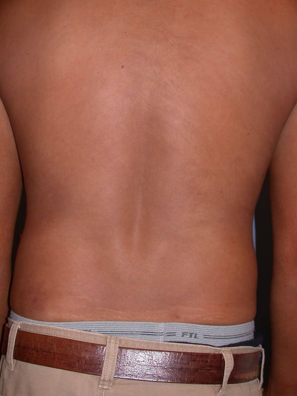 Male Liposuction Gallery Before & After Gallery - Patient 6097149 - Image 7
